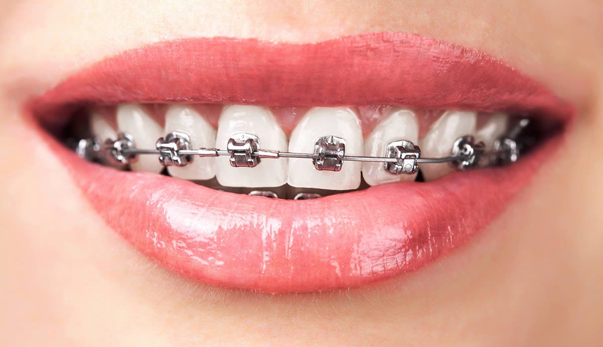 braces