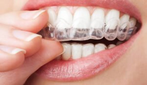 Invisalign Braces