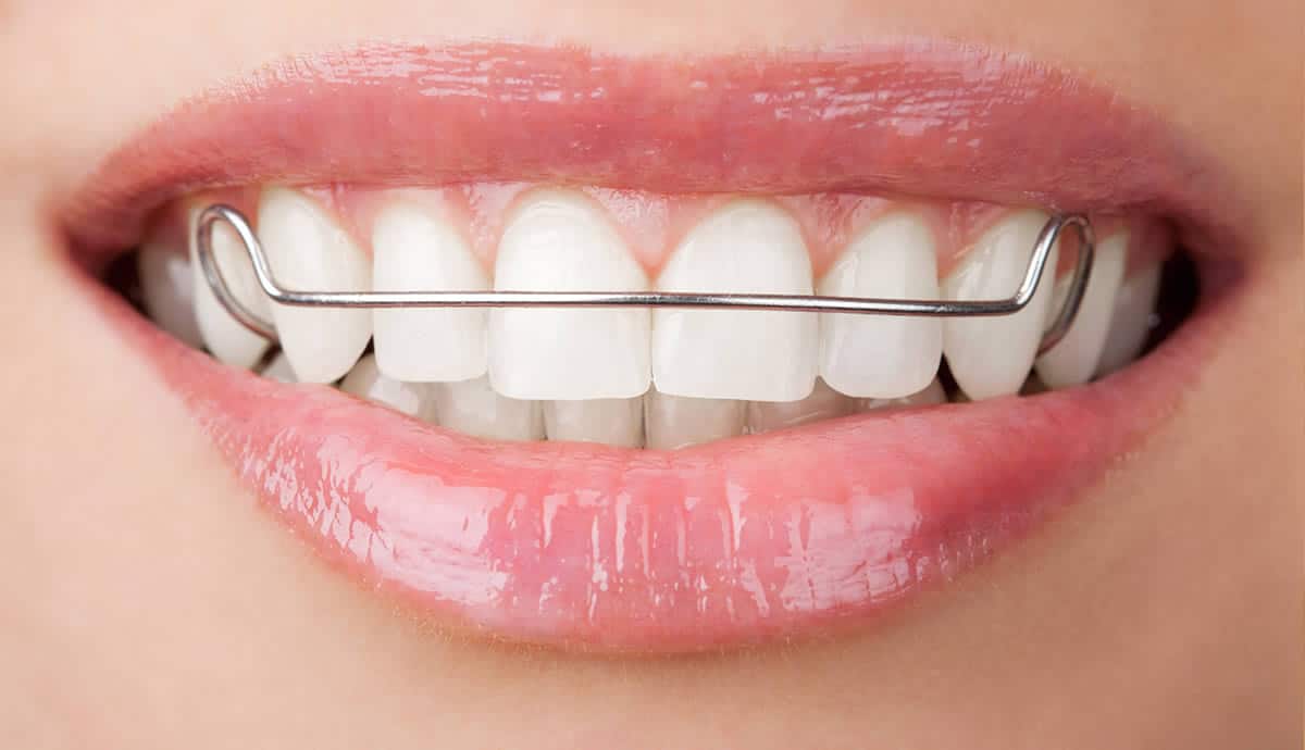 Teeth Jaw And Mouth Plates Shakespeare Orthodontics