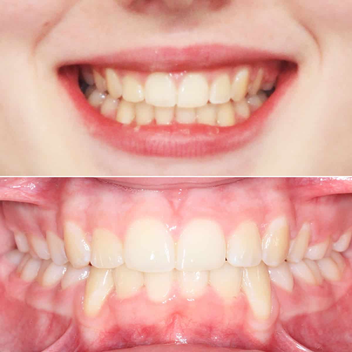 After orthodontic treatment 02