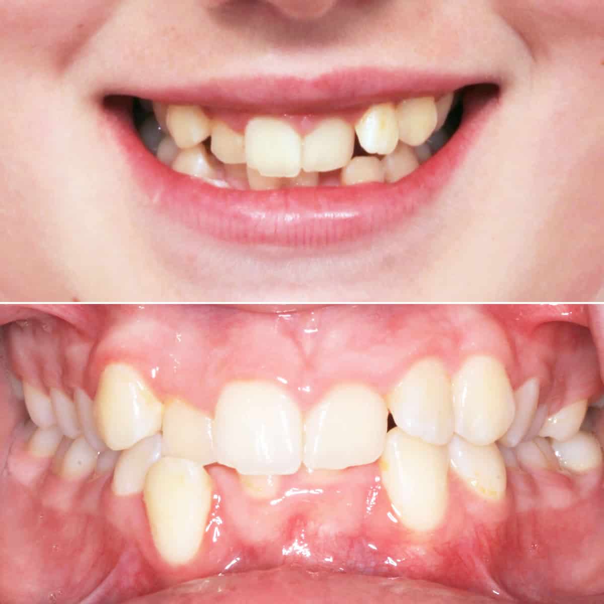 Before orthodontic treatment 02