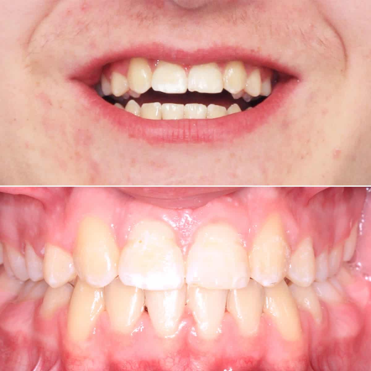 After orthodontic treatment 03