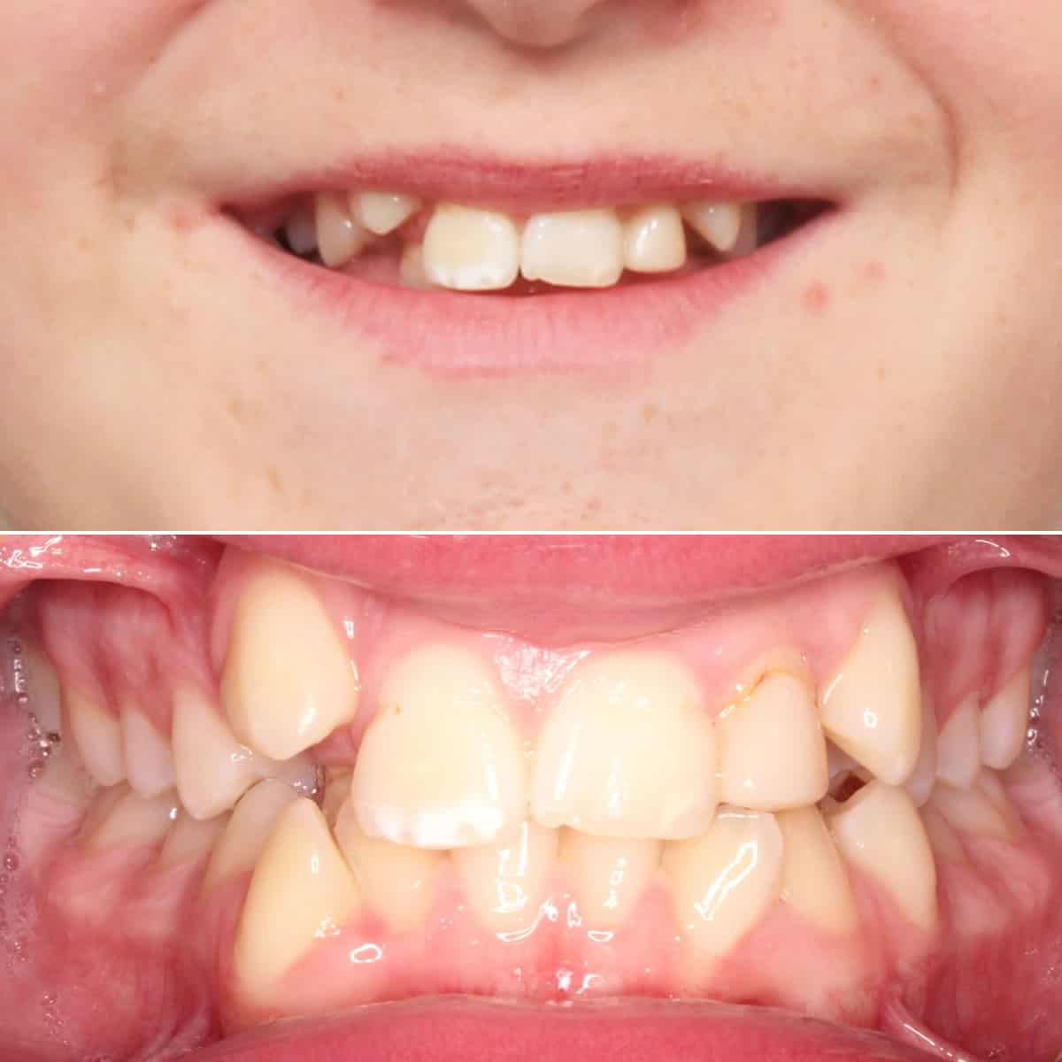 Before orthodontic treatment 03