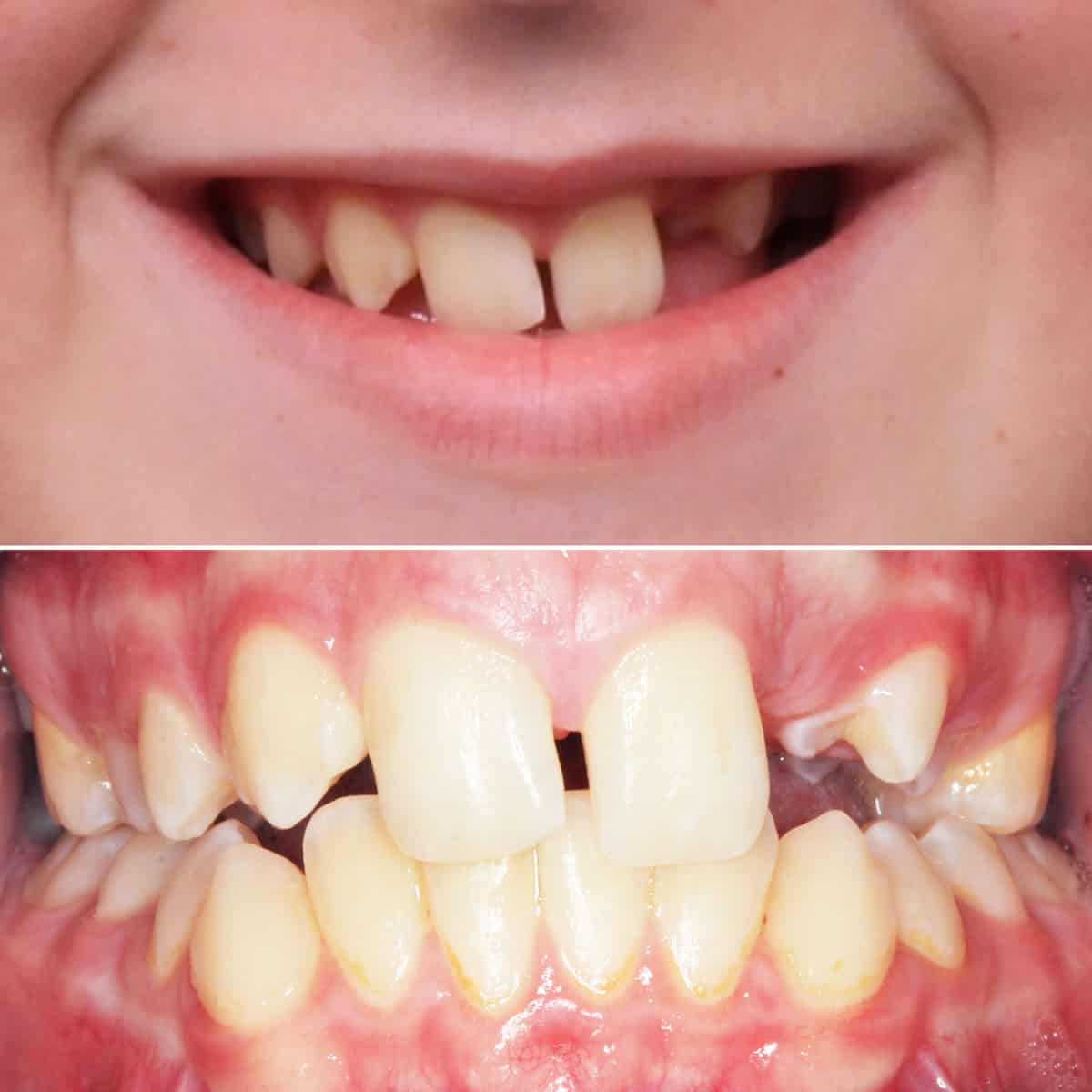 Before orthodontic treatment 01
