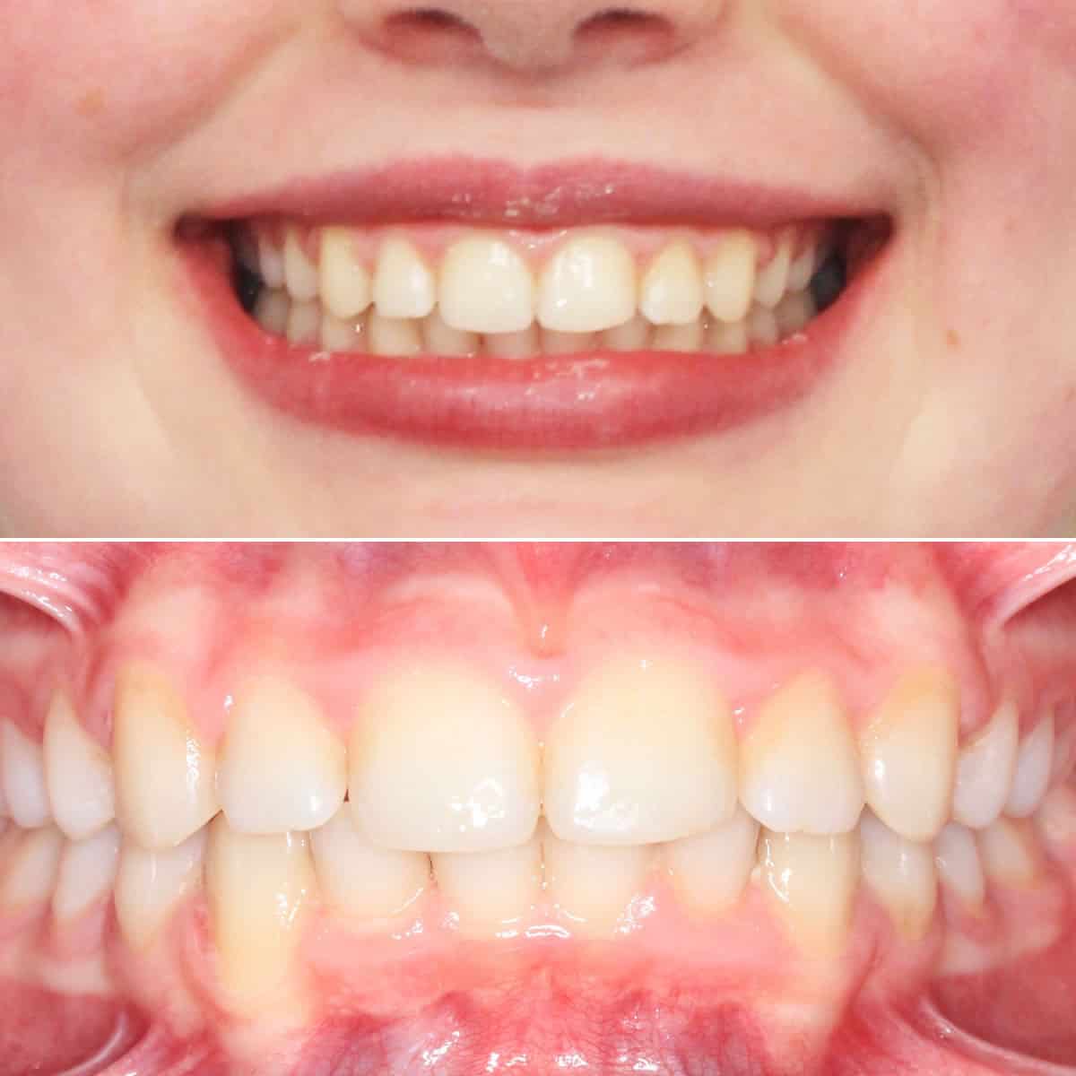 After orthodontic treatment 04