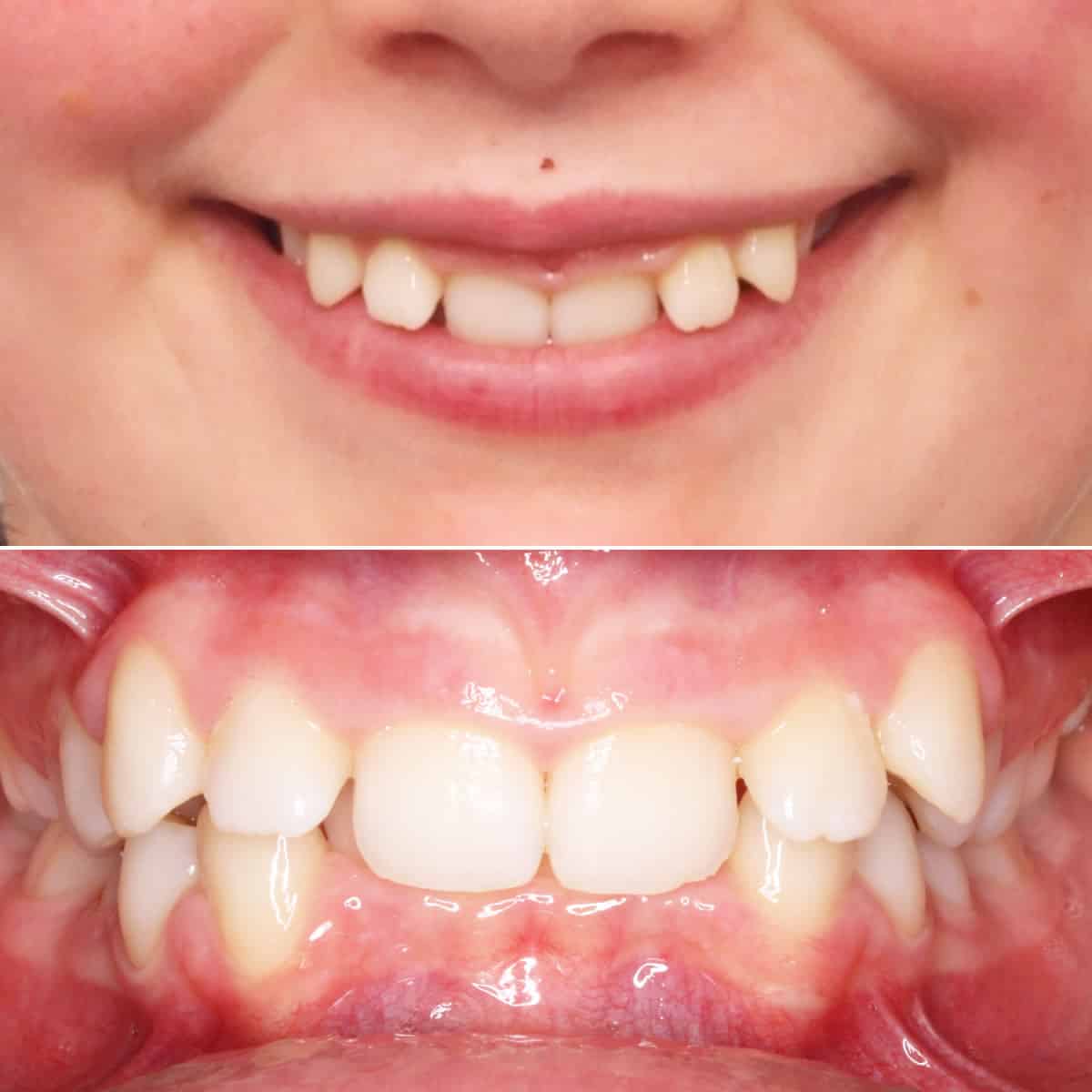 Before orthodontic treatment 04