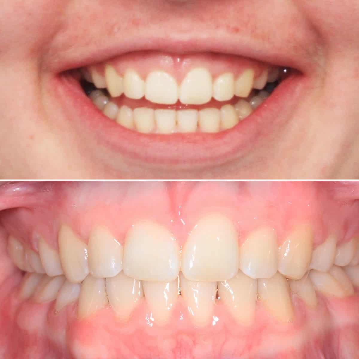 After orthodontic treatment 05
