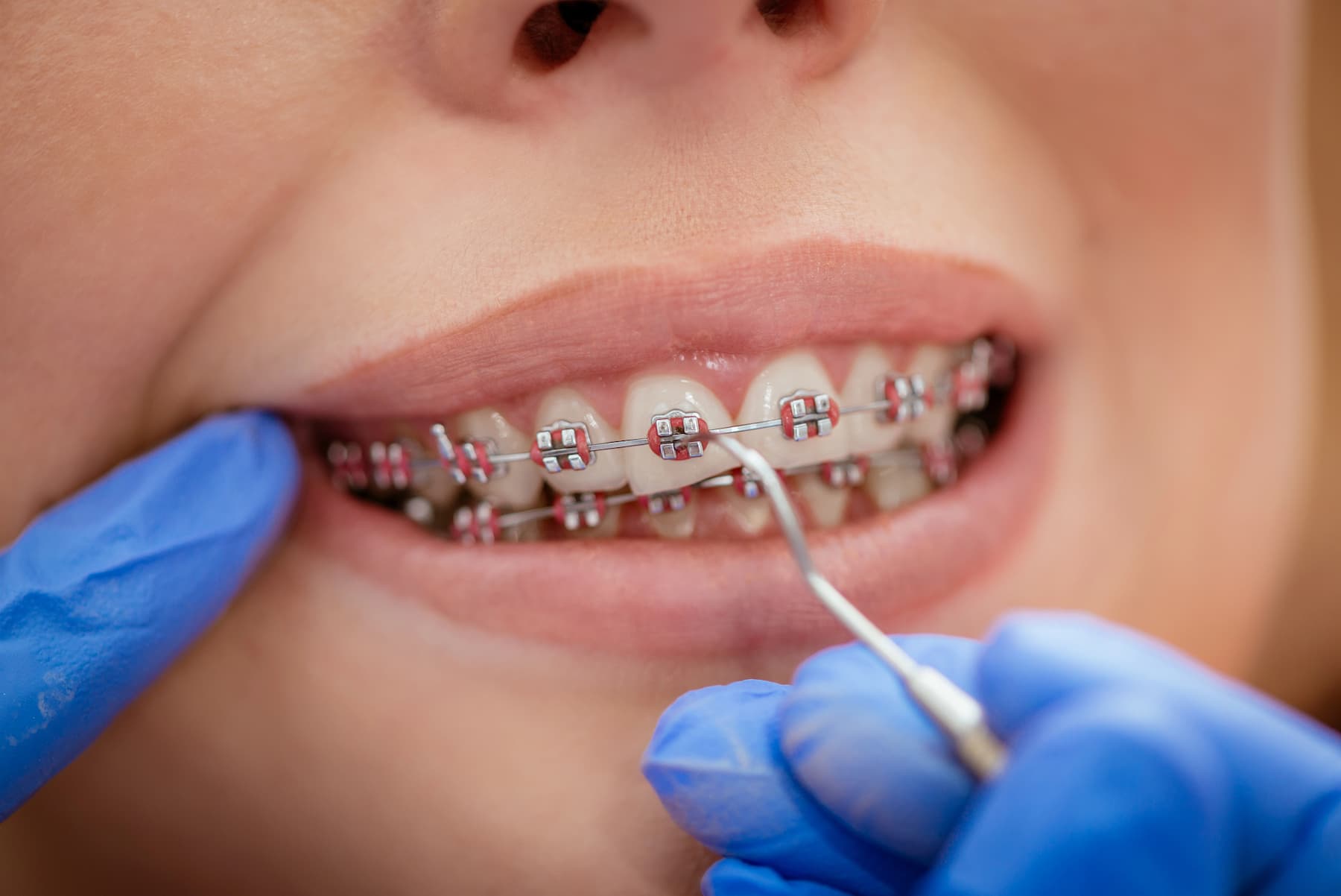 How Long Do Braces Take? Treatment Timelines for Auckland Patients