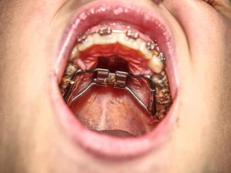 A close-up of braces in a teen's mouth during orthodontic treatment.
